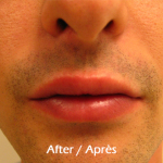 lip filler with restylane after picture in montreal