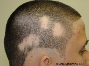 alopecia_areata_1_high