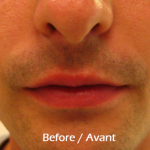 lip filler with restylane before picture in montreal
