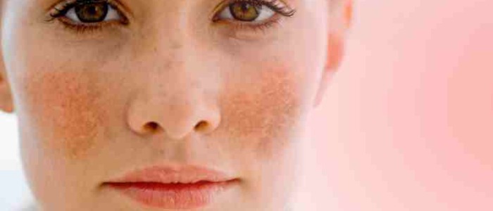 melasma treatment in montreal